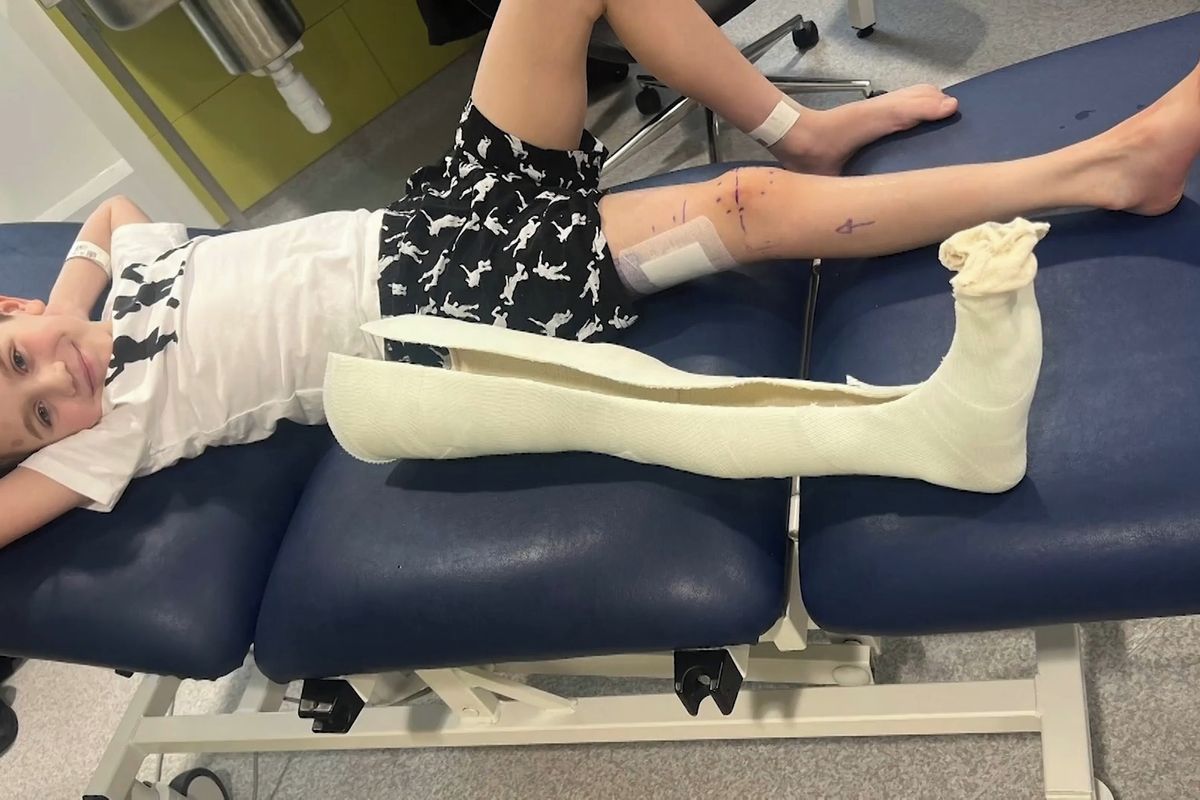 Prodloužení kostí. Průlomová metoda v dětské ortopedii umožňuje rychlý návrat k běžnému životu