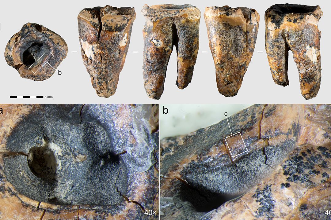 Prvním známým zubařem byl neandertálec z Ruska, ukazuje nová studie