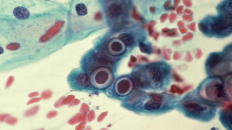 Chlamydie - Chlamydia trachomatis
