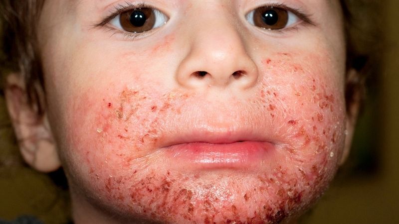 Atopický ekzém je alergické onemocnění kůže. 