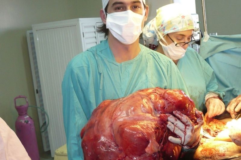 Odoperovaný nádor vážil 23 kilogramů