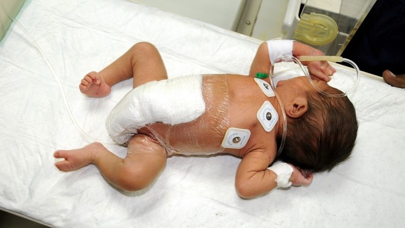 Chlapeček, který se nedávno narodil se šesti nohama, už má po úspěšné operaci jen dvě