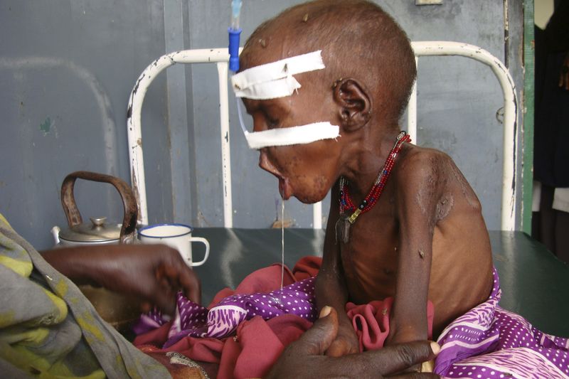 Podvyživený pětiletý chlapec ze somálského jihu
