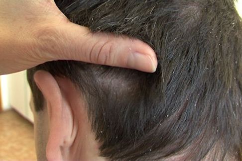 Dermatoložka radí, jak bojovat s lupy ve vlasech