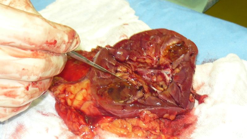 Vyoperovaná ledvina. Na nádor ukazuje pinzeta.