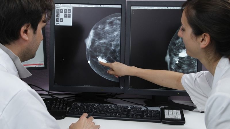 Rentgenový snímek rakoviny prsu. Ilustrační foto