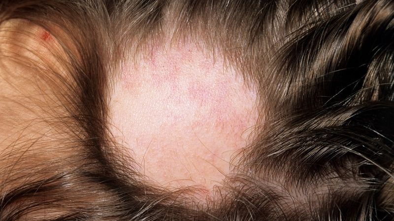 Pro alopecii bývá typické vypadávání koleček vlasů.
