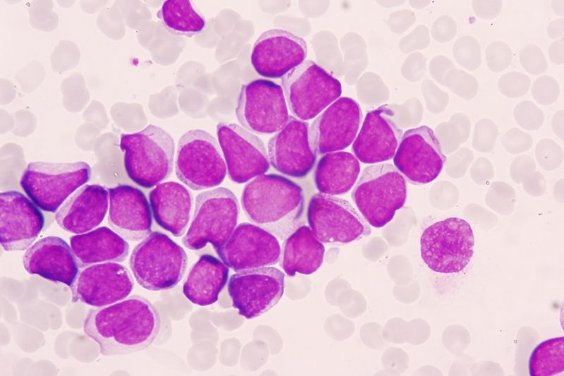Nátěr z kostní dřeně pacienta s akutní leukémií. Buňky jsou obarveny různými barvivy pro lepší viditelnost a rozlišení detailů. Nejsou vidět žádné jiné než nádorové buňky. V pozadí malé růžovo-fialové stíny jsou červené krvinky.