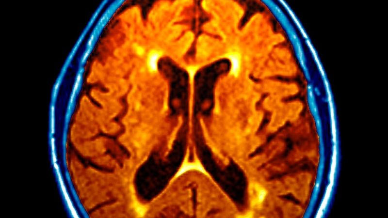 Snímek mozku stiženého demencí