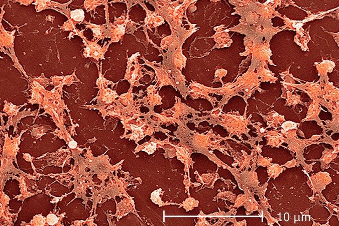 Zlatý stafylokok patří mezi nejčastější původce hnisavých infekcí a intoxikací