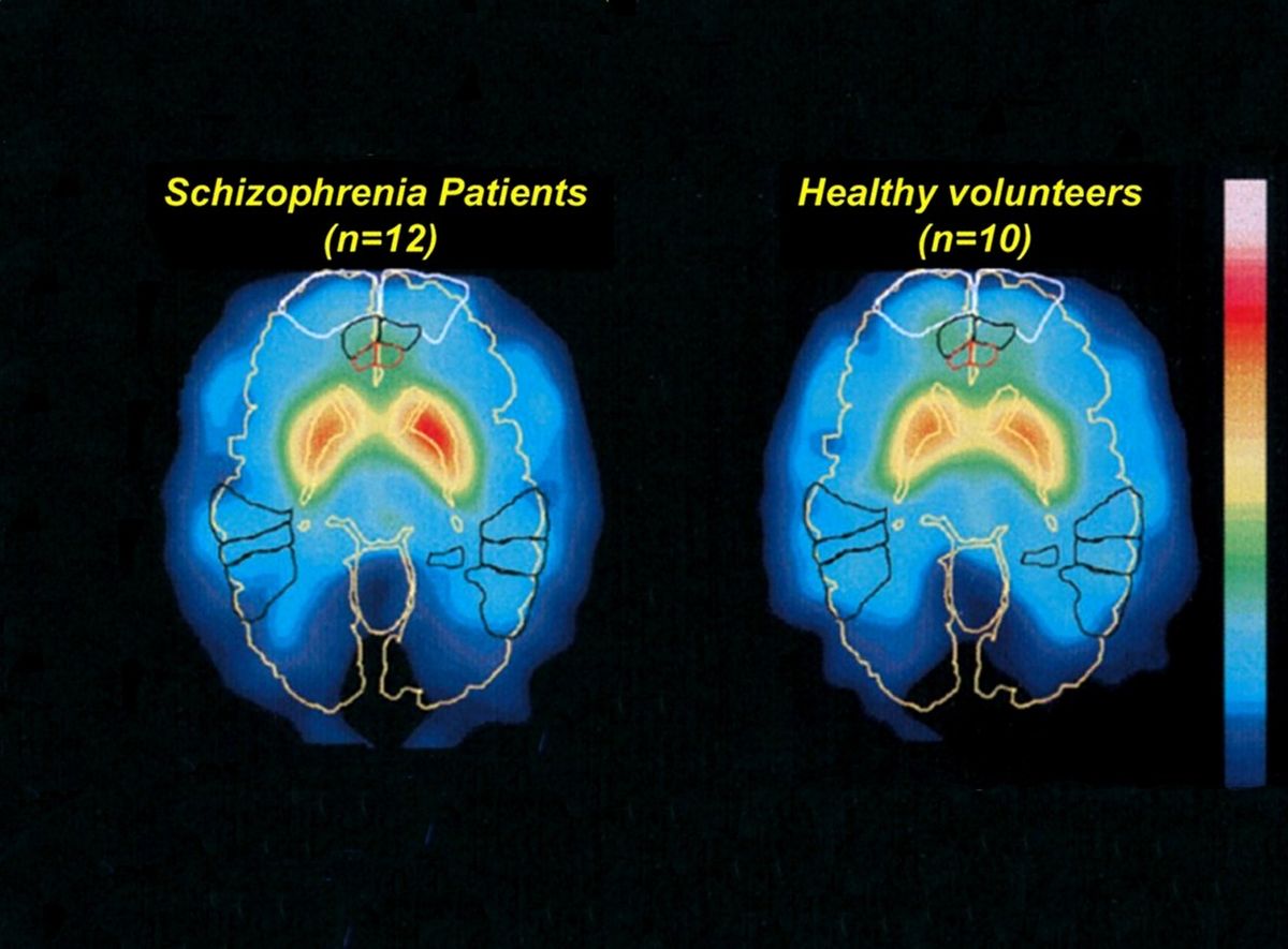 Snímky mozku pořízené pomocí pozitronové emisní tomografie. Vlevo je záběr pacienta postiženého schizofrenií, vpravo mozek zdravého člověka.