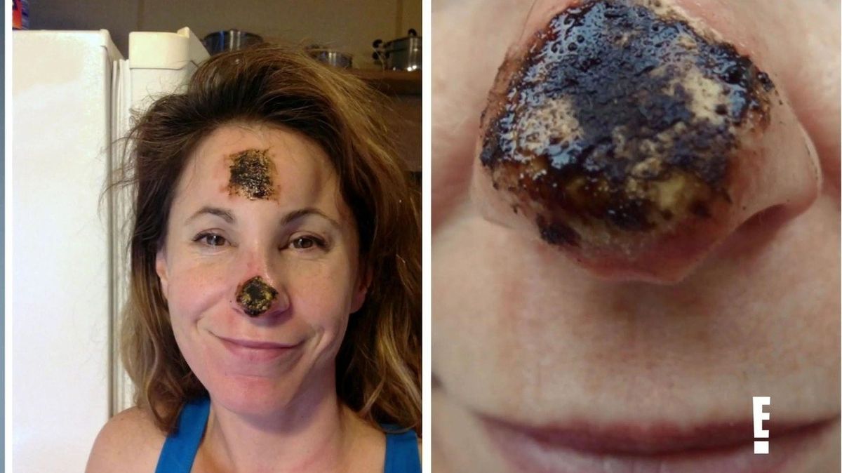 Kelly si vlastní nos zničila používáním zakázané homeopatické mastičky, která jí měla pomoci s léčbou rakoviny kůže. 