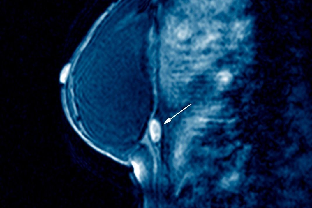 Šipka ukazuje novotvar v prsní tkáni. Ilustrační foto