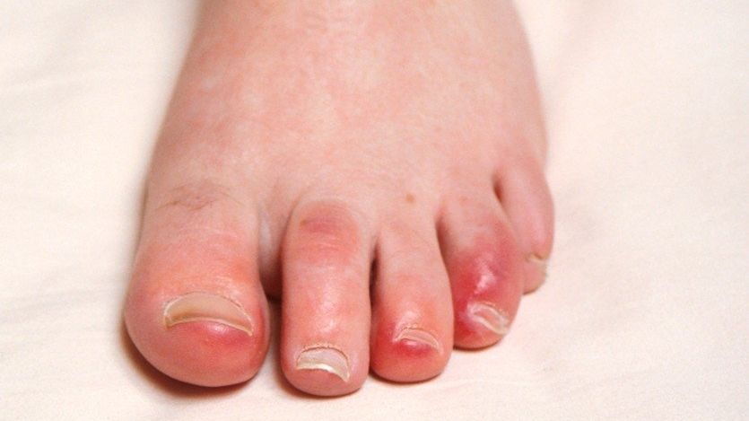 Lehčí forma omrzlin na prstech nohou