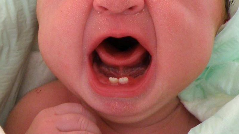 V nemocnici ve Valašském Meziříčí se narodila holčička se dvěma zuby.