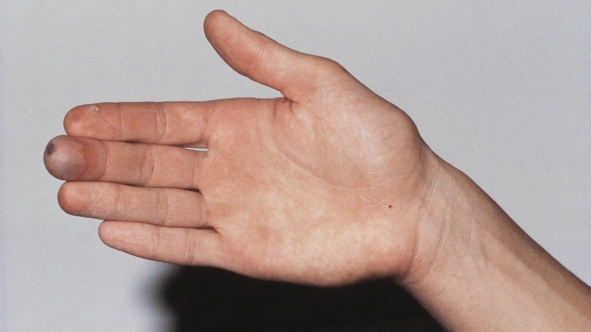 Omrzliny na prstech rukou bývají časté.