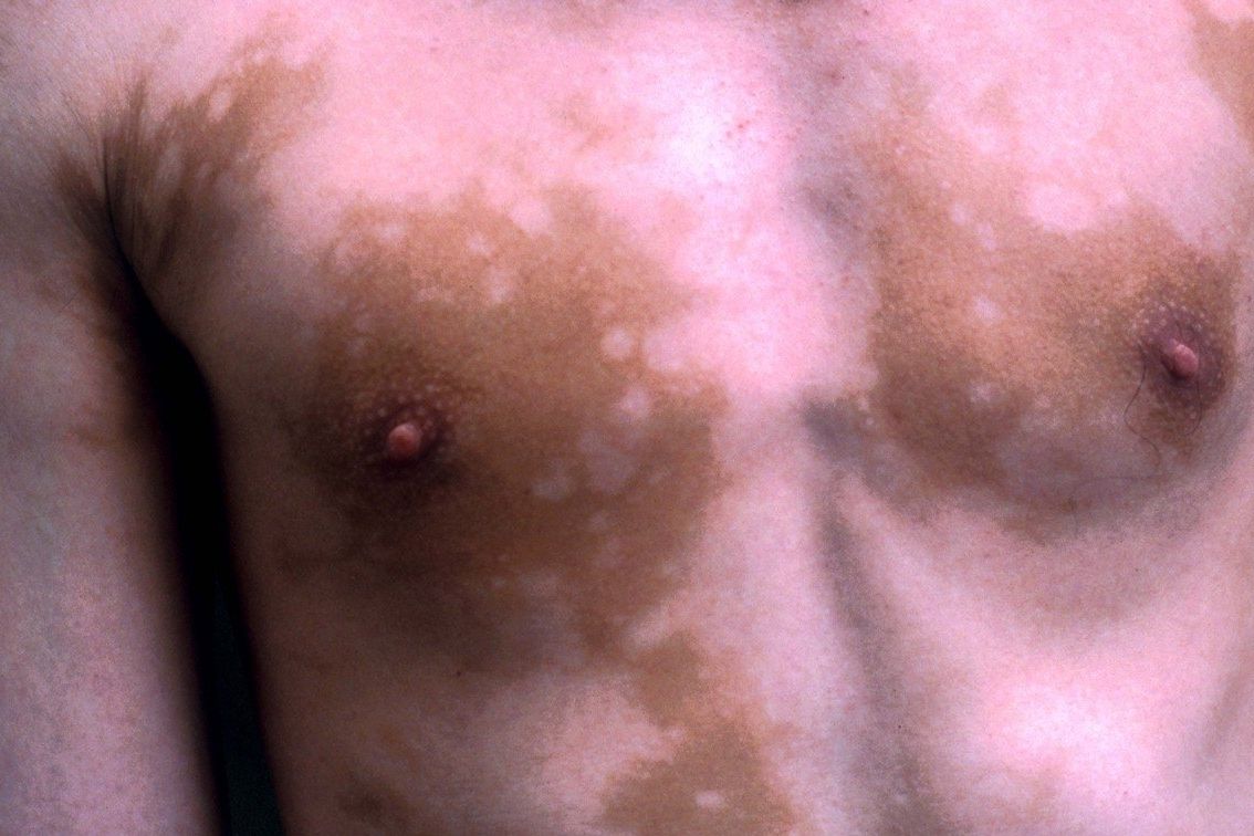 Vitiligo postihuje až dvě procenta populace