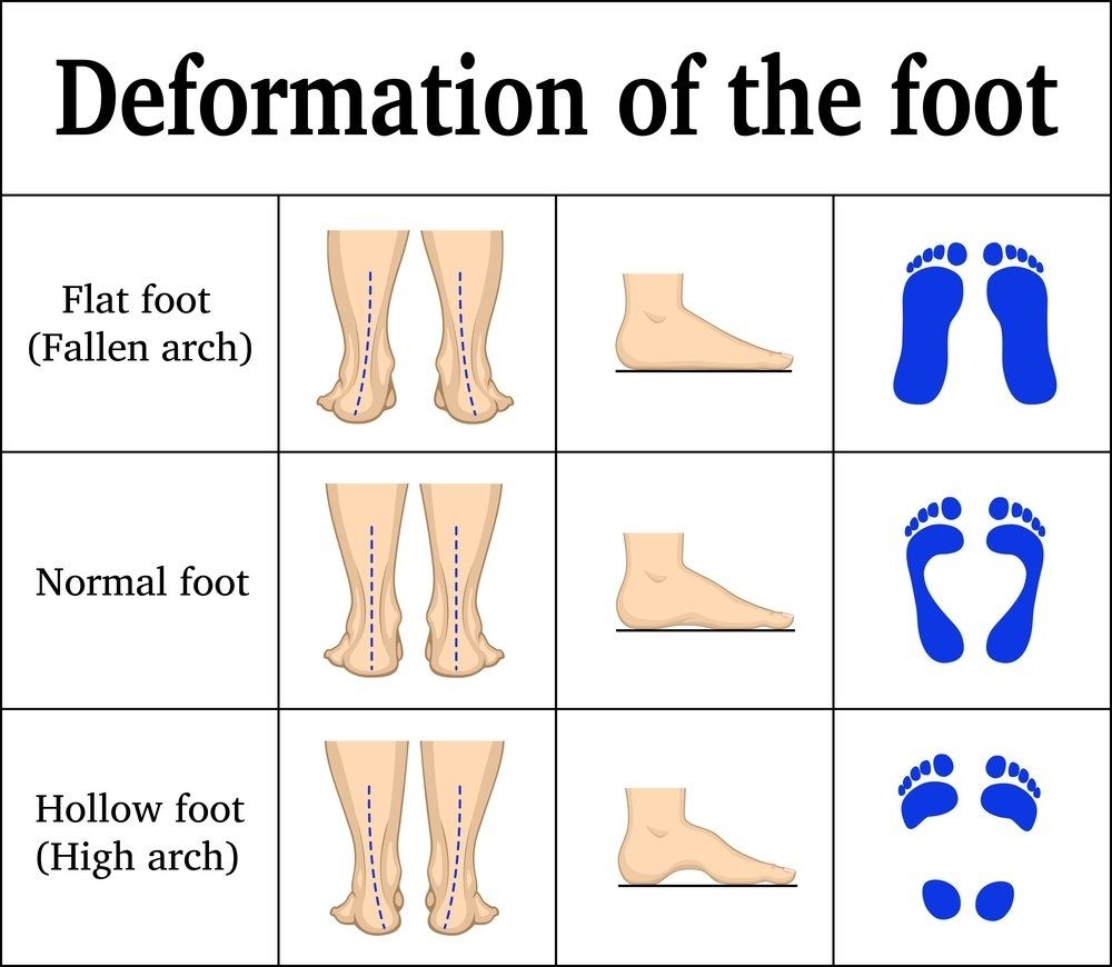 Deformity nohou. 1. Ploché nohy, 2. Normální chodidla, 3. Vyklenutá noha