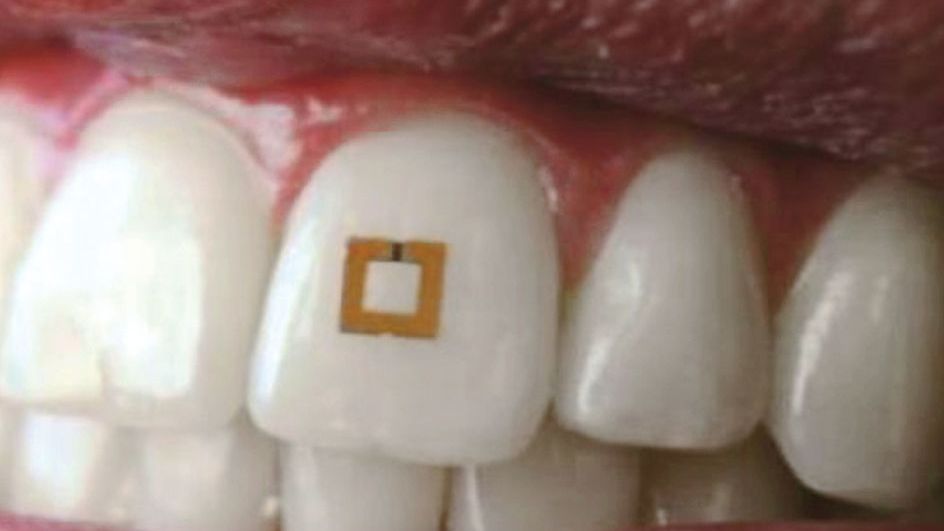 Takto vypadá senzor umístěný na zubu