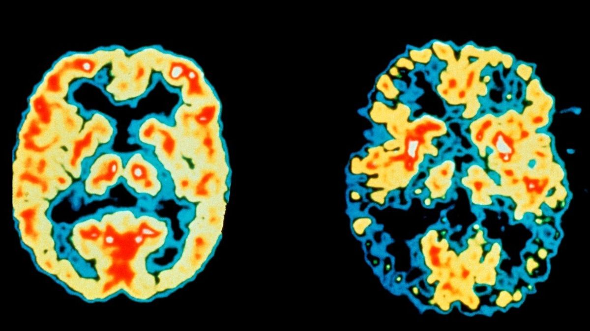 Vlevo snímek zdravého mozku, vpravo postiženého Alzhimerovou chorobou