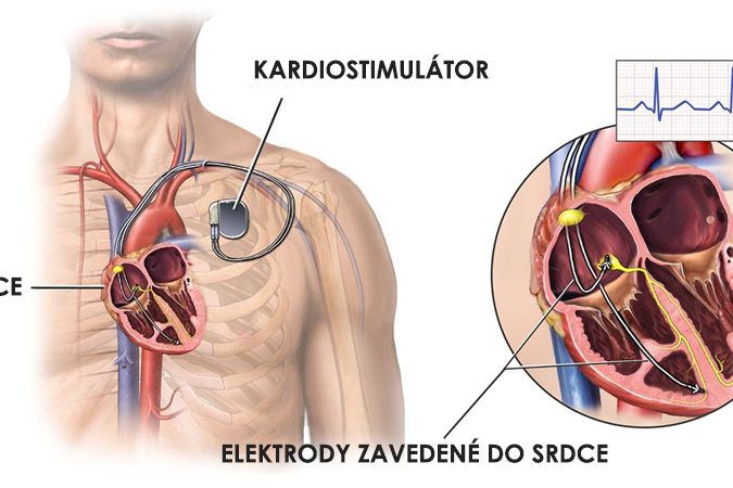 Schéma umístění kardiostimulátoru v těle