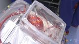 Lékaři v IKEM umí k transplantacím převážet bijící srdce