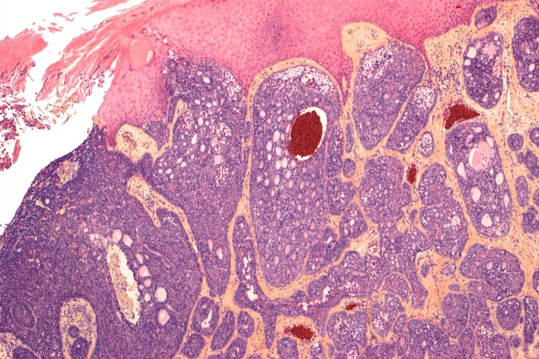 Kožní nádor pod mikroskopem