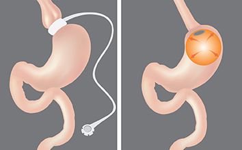 Bandáž, nebo balonek? Operace žaludku změní i produkci hormonů.