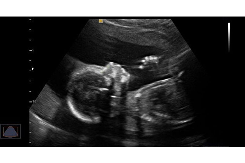 Ilustrační foto 2D ultrazvuku