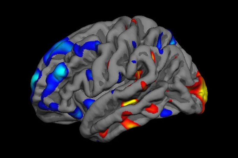 Scan mozku člověka s autismem. Červené a oranžové oblasti jsou větší a silnější než u člověka bez této poruchy, modré naopak slabší 