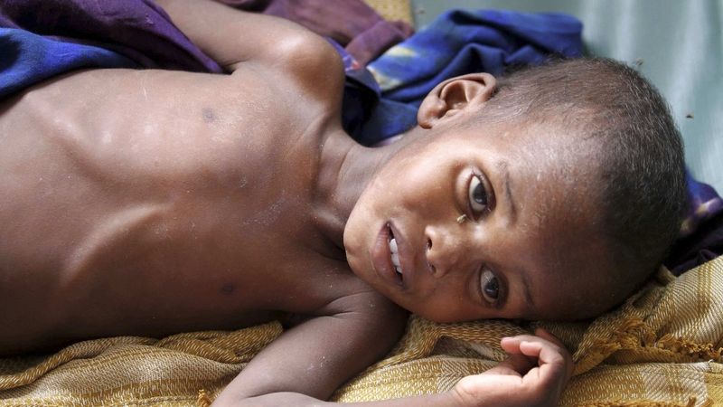 Podvyživené dítě v somálské nemocnici
