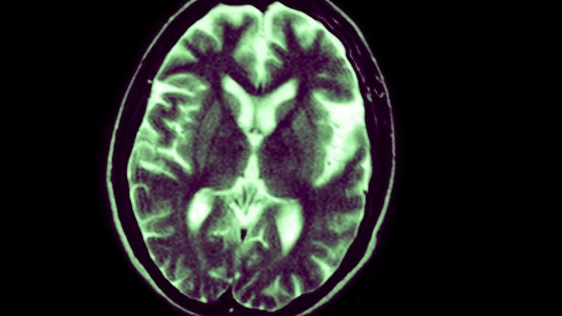 Mozek postižený Alzheimerovou chorobou na magnetické rezonanci