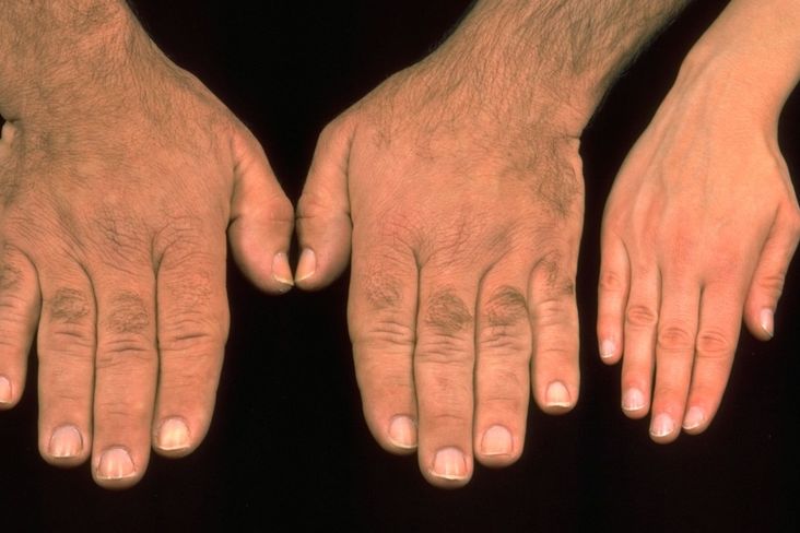 Akromegalie - onemocnění projevující se zvětšováním koncových částí těla a vnitřních orgánů člověka (porovnání ruky zdravého člověka s končetinami nemocného)