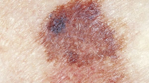 O melanom může jít, pokud znaménko z půl centimetru naroste na dvojnásobek své velikosti. 
