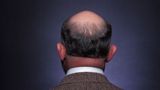 Britští vědci přicházejí s novou možností boje s plešatostí