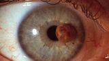 Melanom oka nebolí, ale patří mezi nejagresivnější nádory