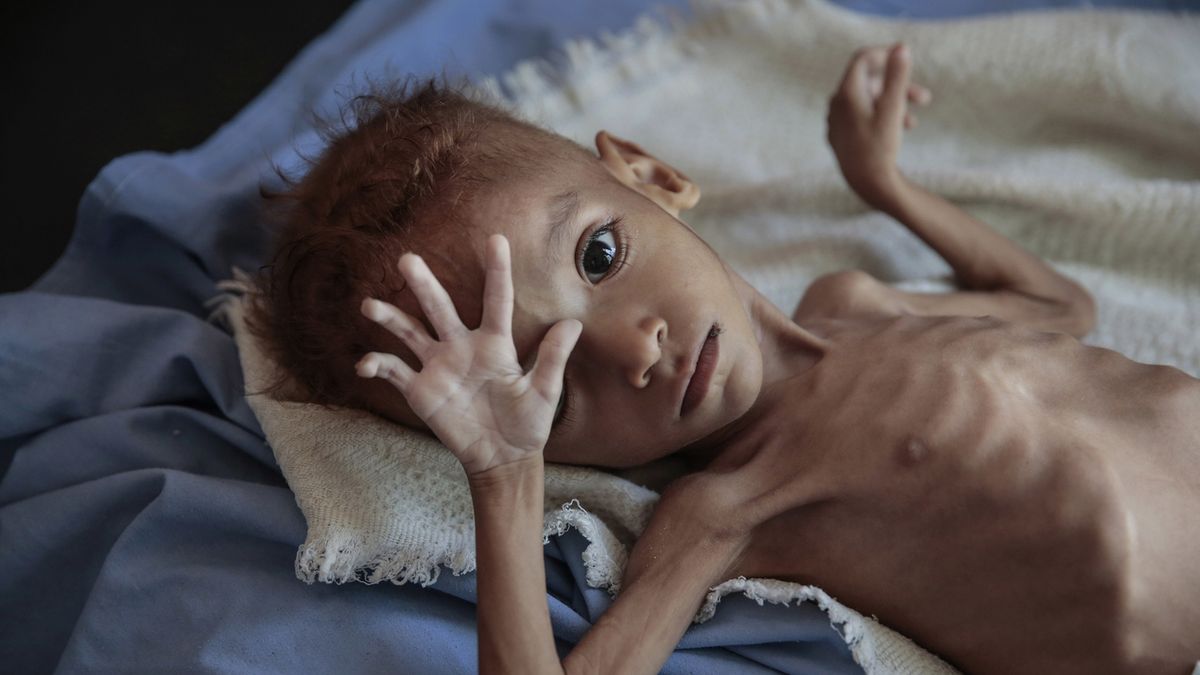 Podvyživený jemenský chlapec 