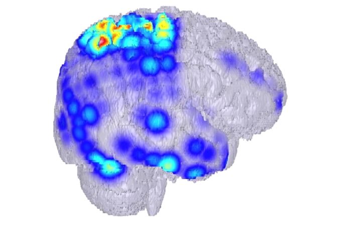 Lidský mozek v průběhu záchvatu