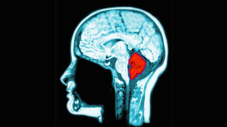 Snímek mozku se zvýrazněnou oblastí malého mozku