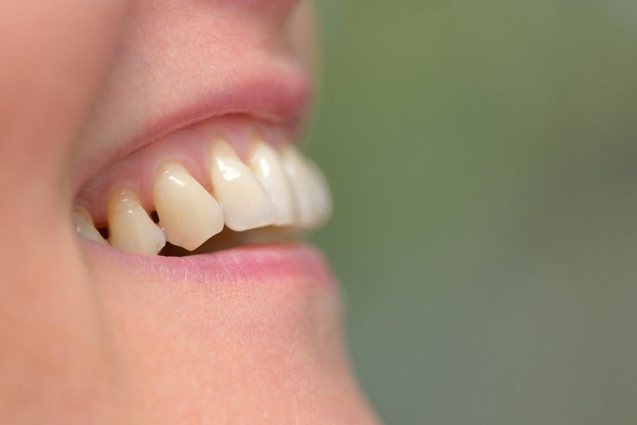 Na parodontitidu mohou upozornit odhalené zubní krčky.