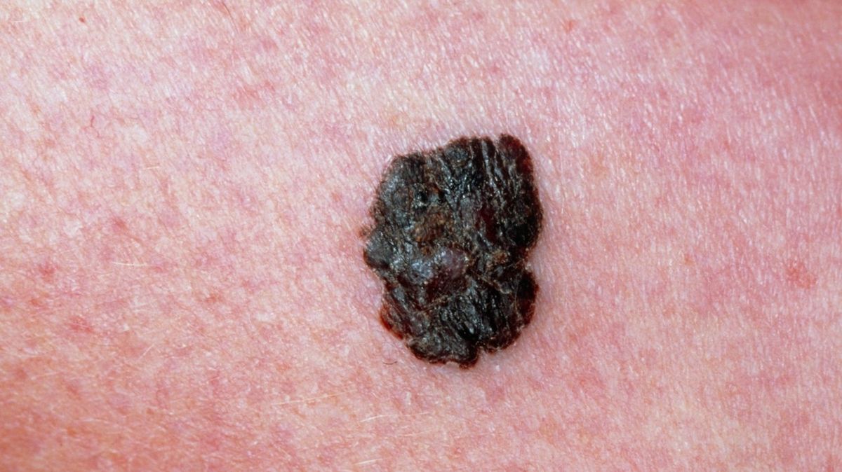 Povrchově se šířící maligní melanom