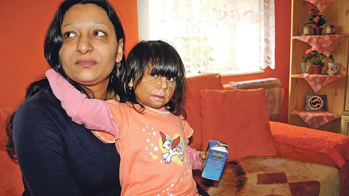 Popálená Natálka dostává od žhářů méně peněz než zdravotní pojišťovna