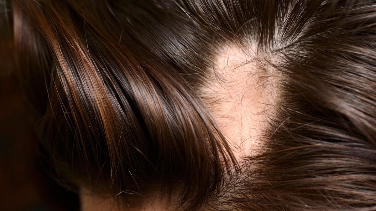 Naděje pro lidi s alopecií. Nový lék až u 40 % z nich nastartuje opětovný růst vlasů