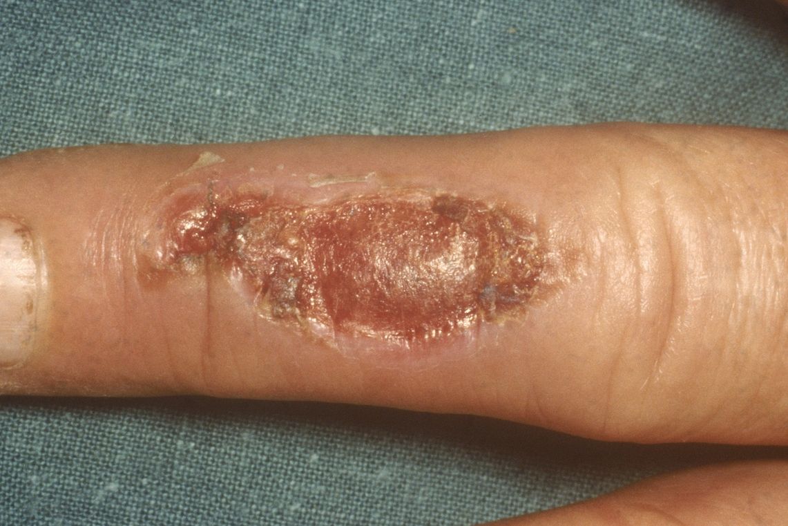 Lepra se v raných fázích projevuje červenými puchýřky