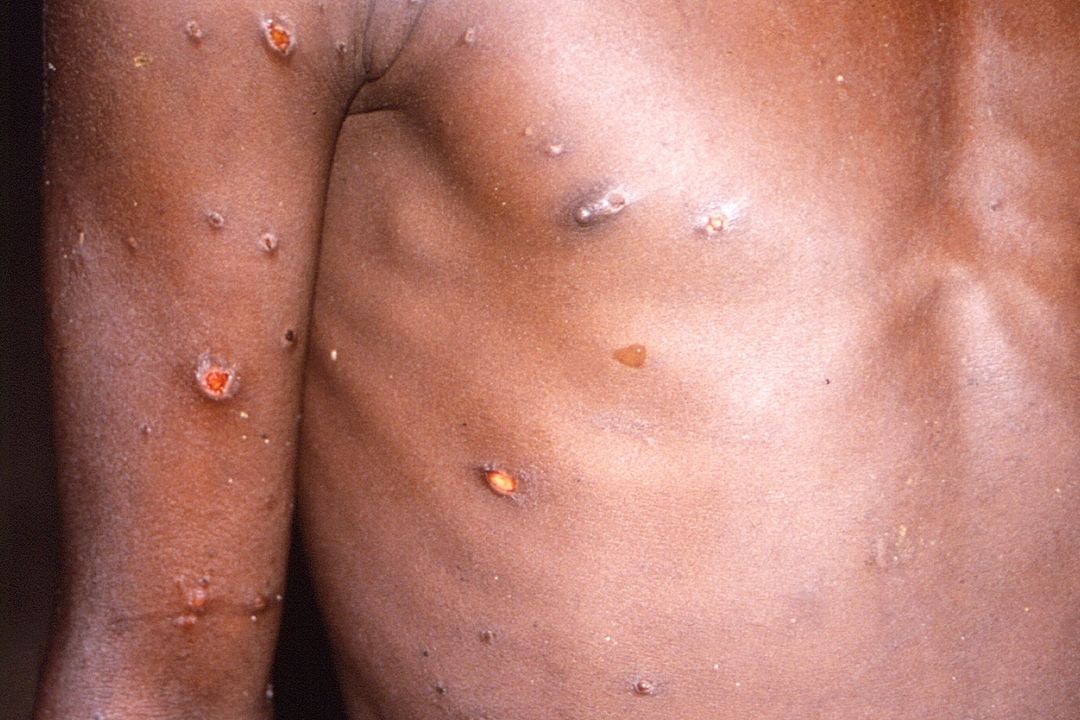 Opičí neštovice (snímek z Konga)