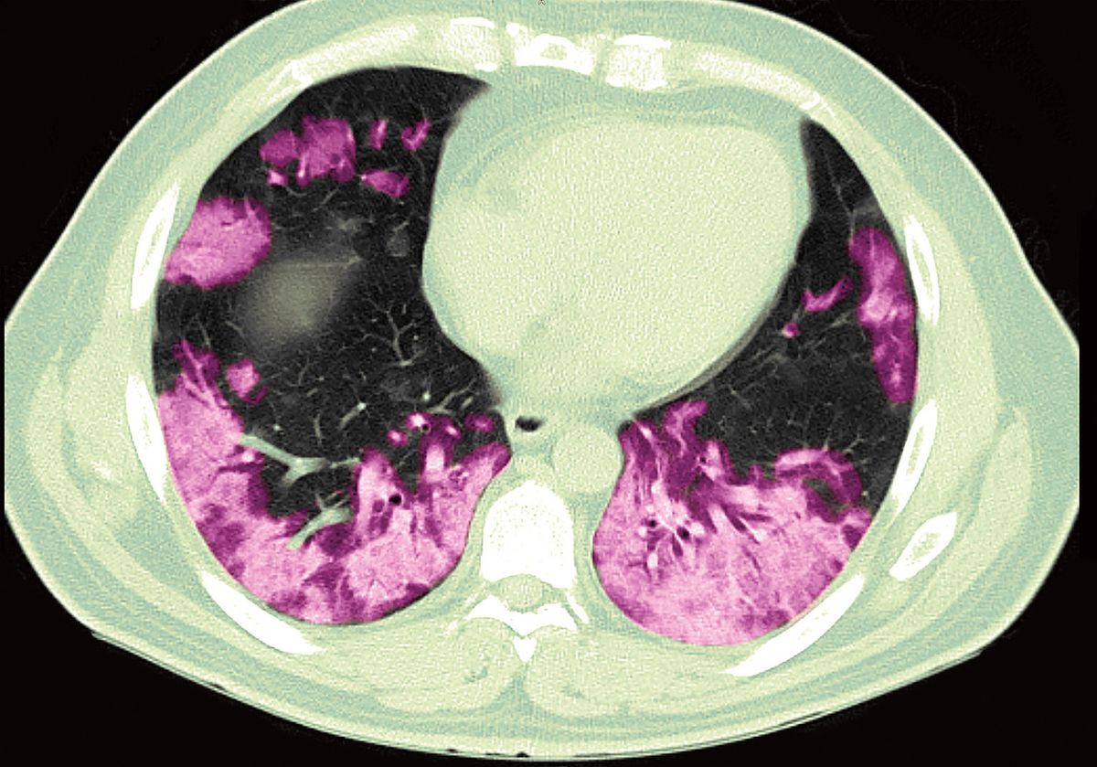 CT snímek plic s covidem-19 (vyznačen fialovou barvou).