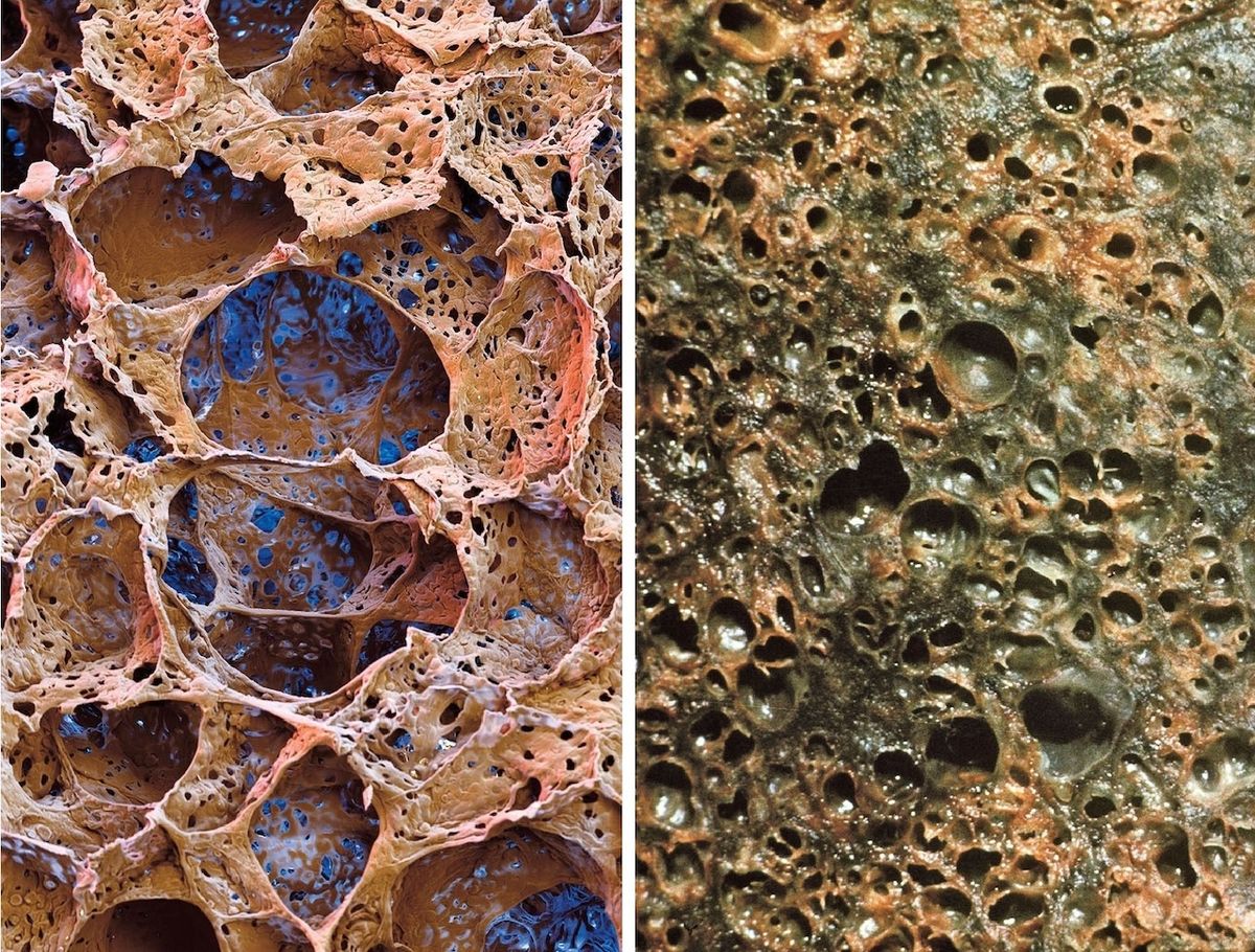 Vlevo: Zdravá plicní tkáň, vedle plicní tkáň poničená fibrózou (závažné a nevratné onemocnění, které vede k postupnému jizvení plicní tkáně).