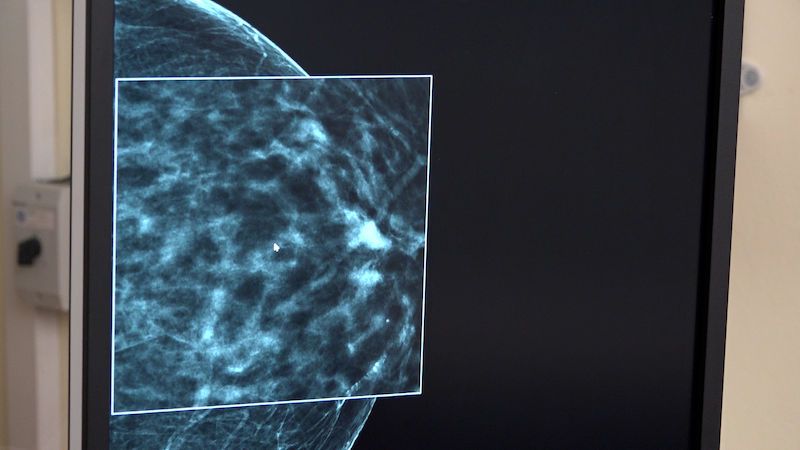 V boji proti rakovině prsu bude na Bulovce pomáhat umělá inteligence