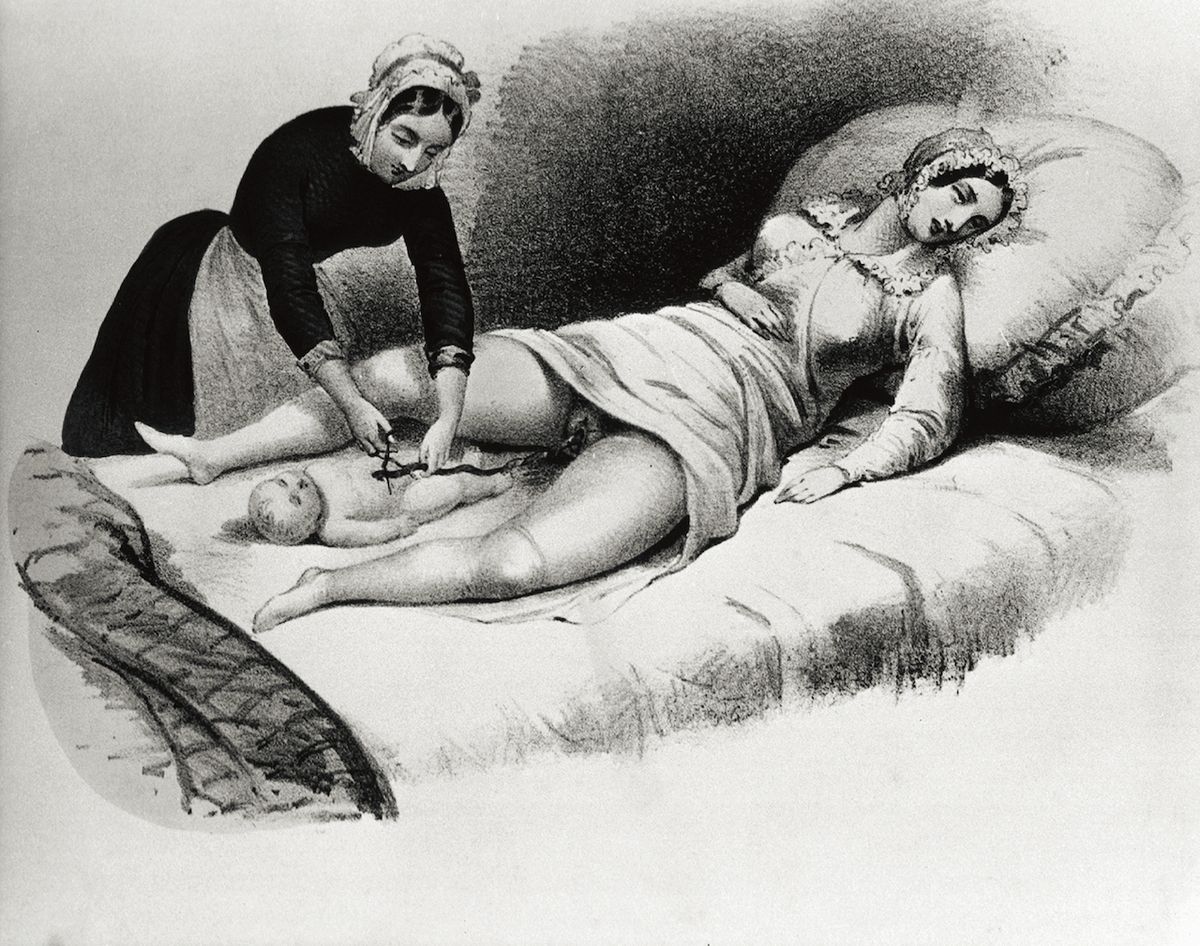 Porodní bába přetíná pupeční šňůru na litografii z roku 1850.