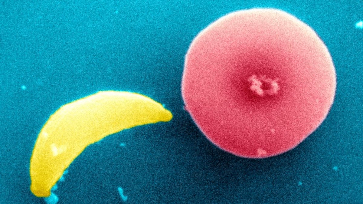 Vědci našli spojitost mezi běžným parazitem a rozvojem agresivních druhů rakoviny